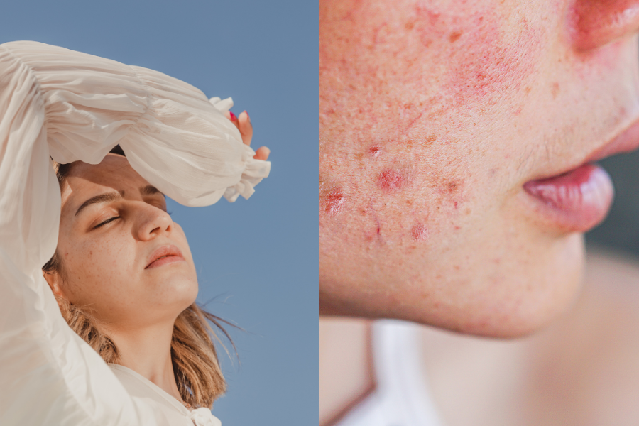 crvena-nadrazena-koza-od-sunca-terrapiaskincare